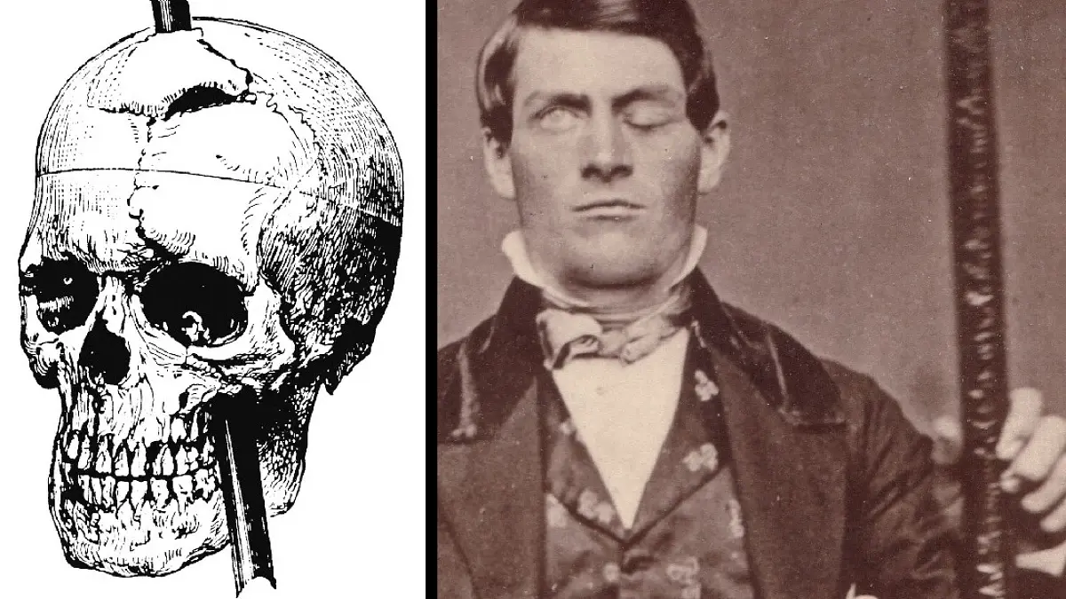 Phineas Gage, el hombre al que una barra de hierro le atravesó la cabeza: qué es verdad y qué es mito
